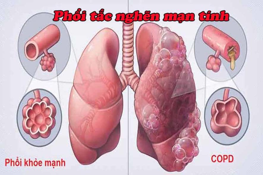 Phòng ngừa bệnh phổi tắc nghẽn mãn tính (COPD)